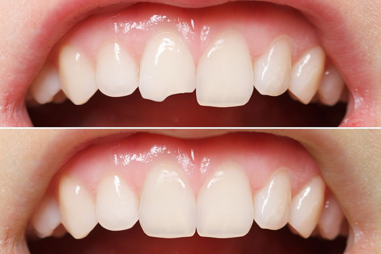 before and after dental bonding
