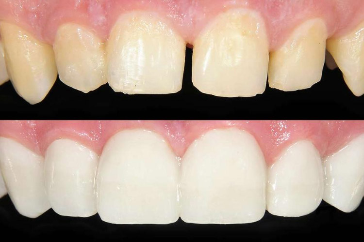 before and after dental bonding