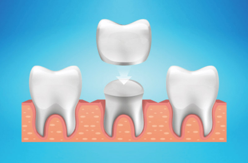 dental crown