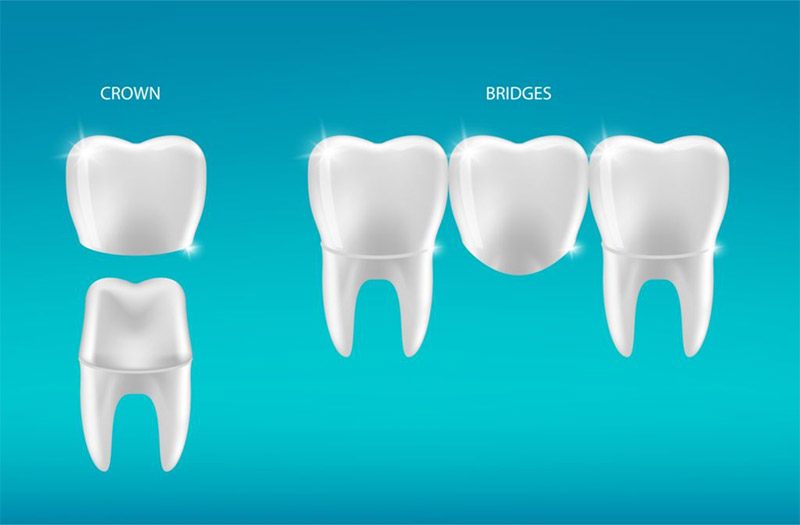 dental crown