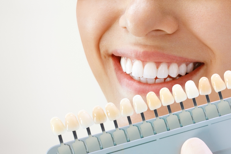 What is the Least Expensive Smile Makeover? featured image